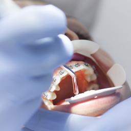 ortodonti-tedavisi-sirasinda-dikkat-edilmesi-gerekenler